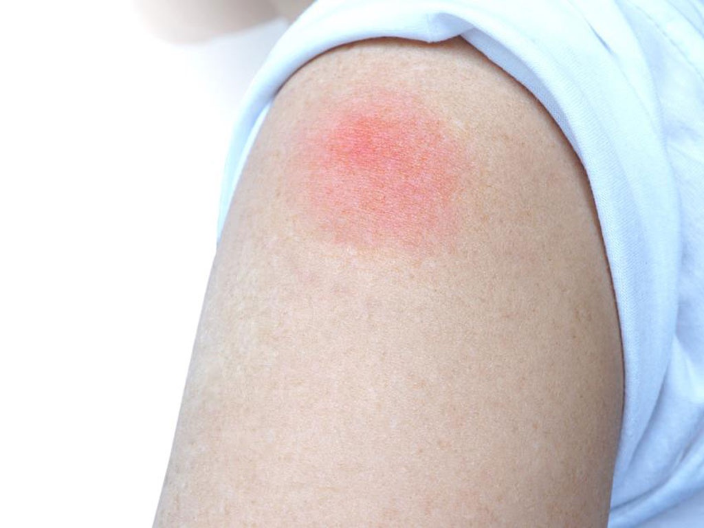 Sưng, đỏ, bầm tím tại vị trí tiêm là một trong những tác dụng phụ của tiêm HPV