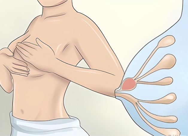 Tắc tia sữa là tình trạng sữa mẹ bị tắc bên trong ống dẫn sữa mà không thể chảy ra ngoài