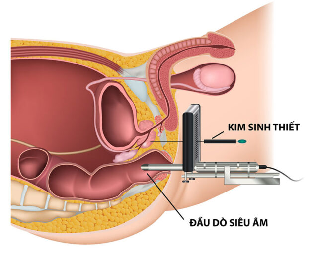 Phương pháp sinh thiết ung thư tiền liệt tuyến