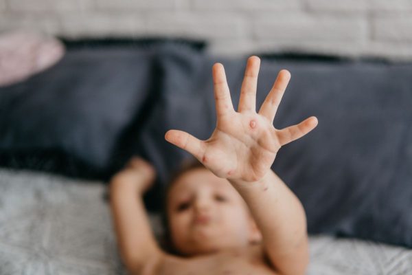 Trẻ mắc thủy đậu thường có các nốt mụn, phỏng nước trên da kèm sốt cao, ngứa ngáy…