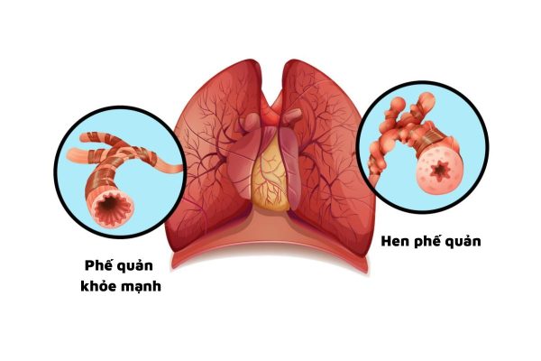 Hen phế quản là bệnh lý thường gặp ở trẻ do hệ hô hấp bị các yếu tố có hại tấn công
