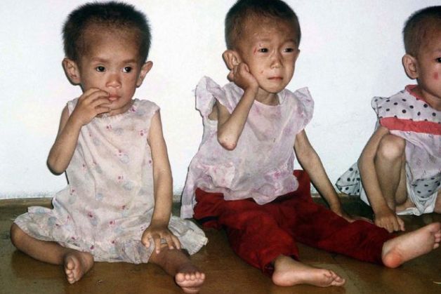 Tình trạng trẻ em bị suy dinh dưỡng ở Việt Nam. 