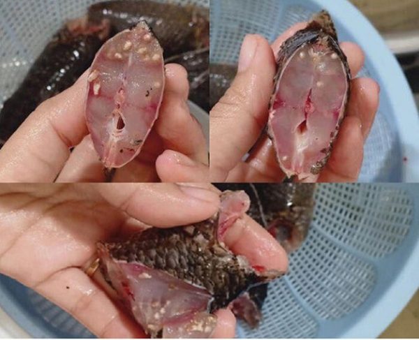 Triệu chứng bệnh sán lá gan điển hình khi ăn phải thực phẩm nhiễm sán là như thế nào?