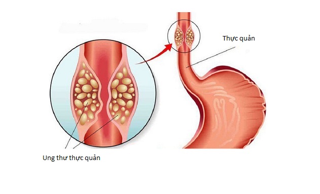 Ung thư thực quản vô cùng nguy hiểm