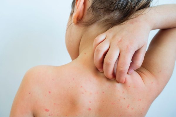 Thủy đậu là một trong những bệnh thường gặp ở trẻ nhỏ với khả năng lây lan cao