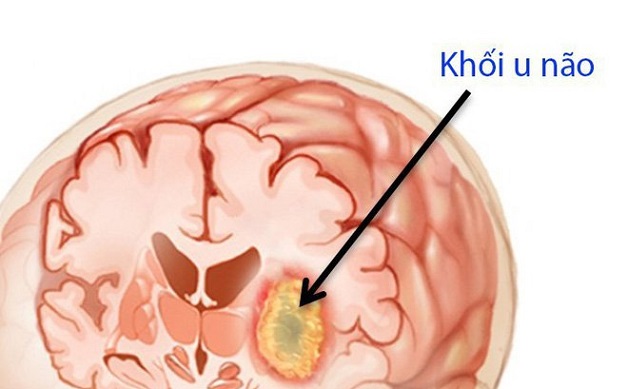 Đau nửa đầu thường xuyên do có khối u trong não phát triển gây chèn ép dây thần kinh và các tế bào não lân cận
