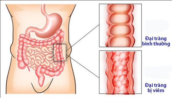 Viêm đại tràng co thắt có nhiều biểu hiện khác nhau