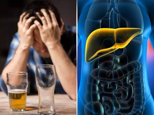 Dấu hiệu cảnh báp viêm gan cấp do rượu