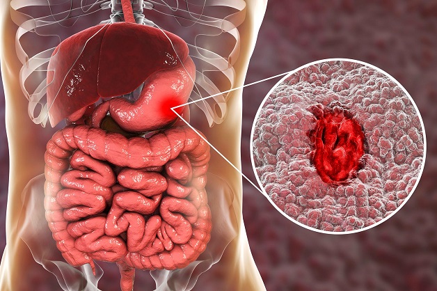 Viêm loét dạ dày là bệnh phổ biến ở hệ tiêu hóa
