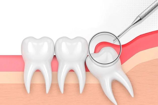 Dấu hiệu nhận biết viêm lợi trùm chân răng.