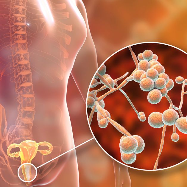 Viêm nấm candida là bệnh gì? Triệu chứng bệnh