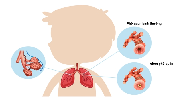 viêm phế quản bội nhiễm