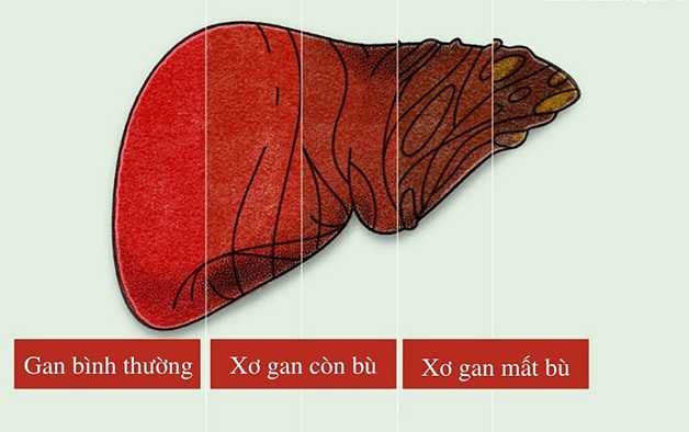 phân biệt xơ gan còn bù mất bù 