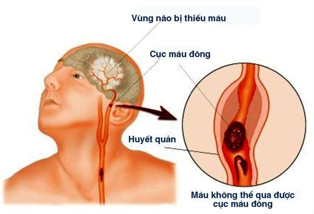Đột quỵ cấp tính thể nhồi máu não