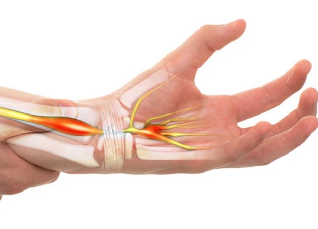 Bệnh viêm dây thần kinh cổ tay