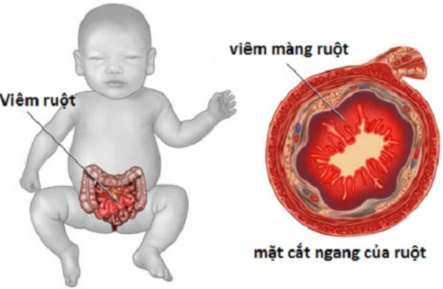 Bệnh viêm ruột hoại tử ở trẻ em