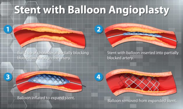 Đặt stent mạch vành hỗ trợ lưu thông máu
