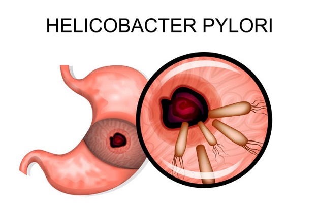 cách điều trị dạ dày hp