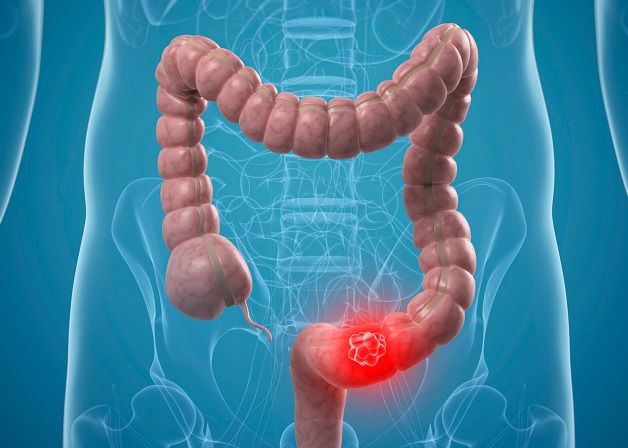 Tìm hiểu bệnh Crohn có nguy hiểm không