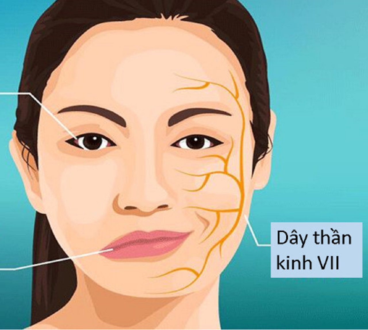 Liệt dây thần kinh số 7 chủ yếu gây ảnh hưởng đến tâm lý người mẹ hơn là trực tiếp đến thai nhi