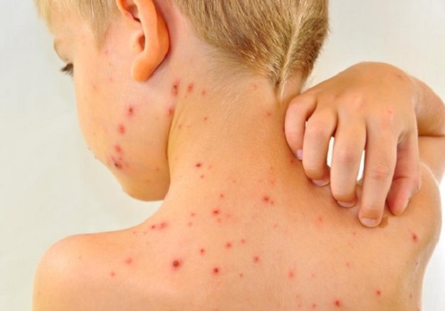 vắc xin sởi tiêm lúc nào