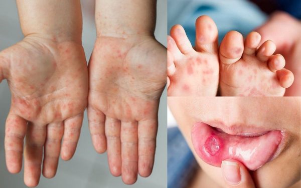 Sốt, có những nốt phỏng nước tại chân, tay, mông... là những dấu hiệu điển hình của bệnh tay chân miệng