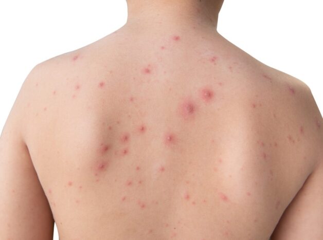 Mụn nước là triệu chứng điển hình của thủy đậu