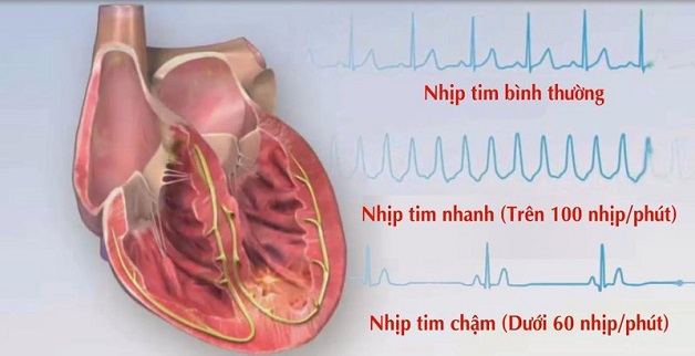 Bệnh nhân có cơ tim thiếu máu có thể gặp các biến chứng gì?