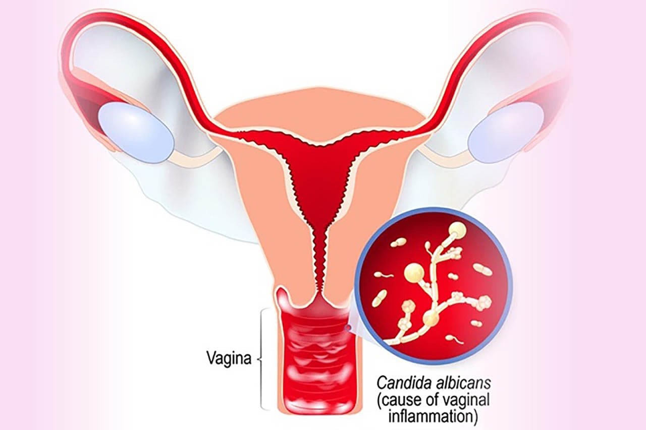 Nấm âm đạo xảy ra khi nấm Candida Albicans có điều kiện phát triển mạnh mẽ và gây ra bệnh