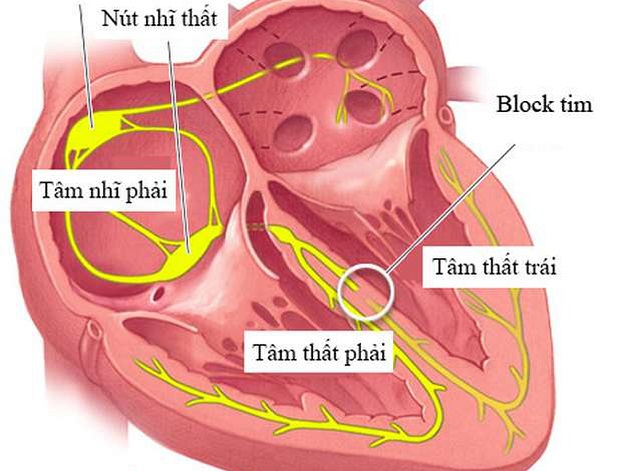 Các dạng rối loạn nhịp chậm