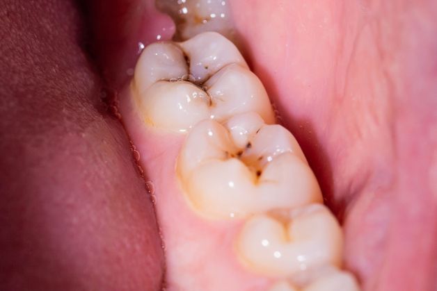 Dấu hiệu và cách chữa răng sâu hiệu quả.