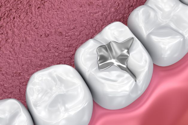 Cách chữa sâu răng hữu hiệu