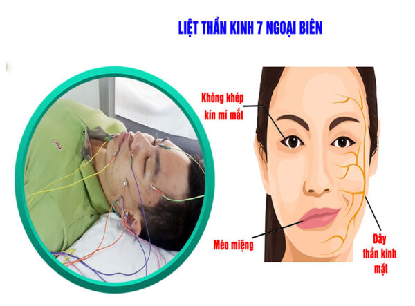 chẩn đoán liệt dây thần kinh số 7 ngoại biên