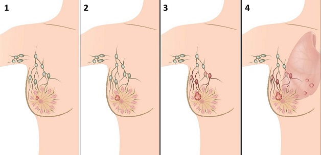 cách tầm soát ung thư vú