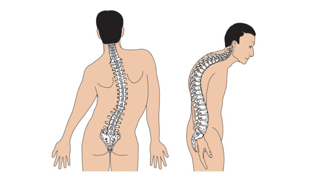 Vẹo cột sống là một di chứng của còi xương
