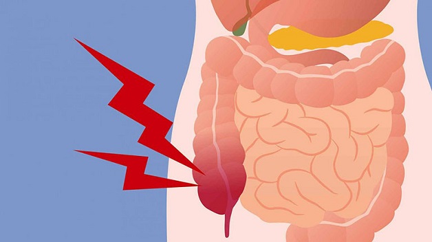 Đau bụng viêm đại tràng là dấu hiệu dễ nhận biết của bệnh