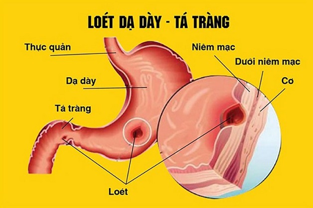 cách điều trị bệnh viêm loét dạ dày