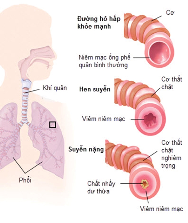 điều trị hen ở trẻ em