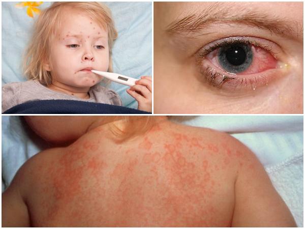 sốt siêu vi có triệu chứng điển hình là sốt, trẻ mêt mỏi, phát ban