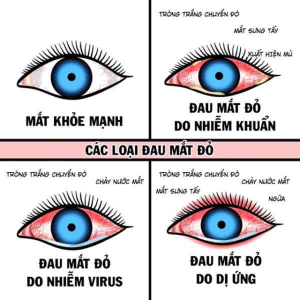 Những nguyên nhân dẫn đến viêm kết mạc