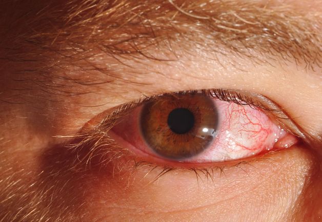 Viêm kết mạc là một trong những bệnh phổ biến liên quan đến mắt do nhiều nguyên nhân gây ra