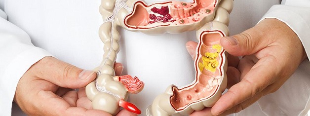 cách điều trị viêm loét đại tràng