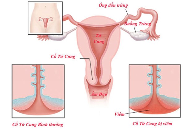 bệnh phụ khoa