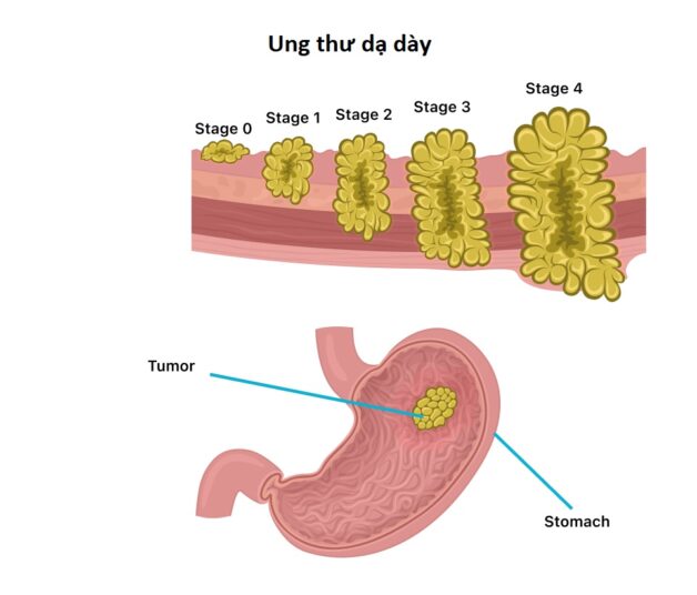 Phẫu thuật cắt dạ dày có sống được không