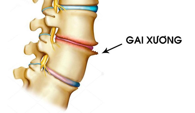 hình ảnh cho biết gai đốt sống cổ là bệnh gì? 