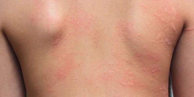 DO thường xuyên tiếp xúc với hóa chất, chất bẩn, người lao động ngành xây dựng dễ mắc phải các bệnh da liễu