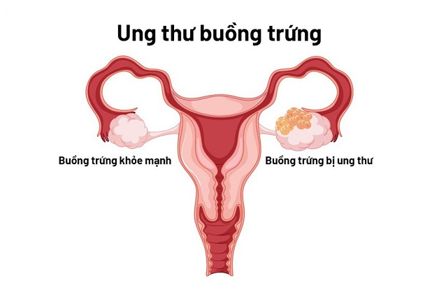 sàng lọc ung thư buồng trứng