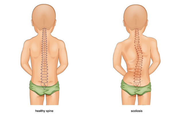 Vẹo cột sống là một trong những di chứng vĩnh viễn của còi xương