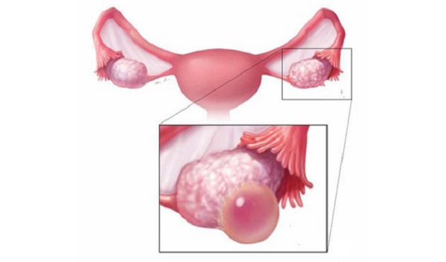 kích thước nang hoàng thể
