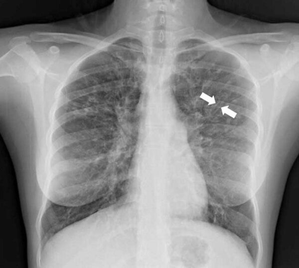 Nguyên nhân dẫn đến giãn phế quản có thể do virus, vi khuẩn 